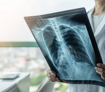 Doctor diagnosing patientâs health on asthma, lung disease, COVID-19 or bone cancer illness with radiological chest x-ray film for medical healthcare hospital service